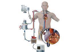 Extracorporeal membrane oxygenation (ecmo) procedure is a type of life support used for babies and children. Ecmo As Bridge To Lung Transplant Penn Medicine