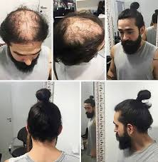 This is your ultimate resource to get the hottest hairstyles and haircuts in 2021. Men Are Hiding Baldness With Man Buns But It S Riskier Than You Think Bored Panda