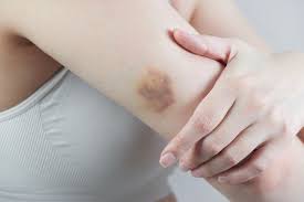 Hemofilia merupakan kelainan pada proses pembekuan darah. Tubuh Mudah Memar Kenali 7 Tanda Kekurangan Vitamin K