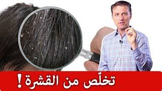 كيفية التخلص من قشرة الشعر بشكل نهائي؟