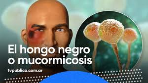El hongo negro, anteriormente llamado cigomicosis, es por definición una infección fúngica grave pero en india los hospitales están viendo un alarmante aumento de los casos de mucormicosis. El Vinculo Entre El Hongo Negro O Mucormicosis Y El Covid 19 La Liga De La Ciencia Youtube