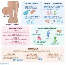 Image result for Edema