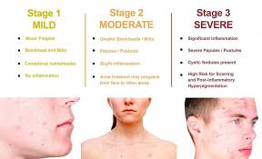 Image result for acne face