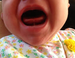 Dental cavities are common, but not normal. My Baby Is Tongue Tied The Second 9 Months