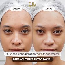 Udah 2024 masih breakout aja? 😱 Yakin nggak mau kamu beresin dulu masalah  breakout ini sebelum makin meradang? 😱 Ella Skin Clinic hadirkan treatment  yang dapat menyelesaikan masalah bruntusan, bekas jerawat hitam,