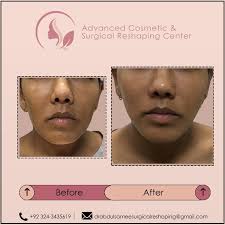 Advanced Cosmetic and Surgical Reshaping Center (@dr.abdulsamee) •  Instagram photos and videos