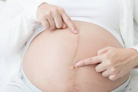 妊娠中にできる「正中線」って何？ 妊娠線との違い・ケア方法