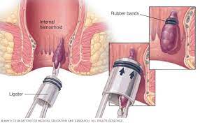 Hemorrhoids - Diagnosis And Treatment - Mayo Clinic