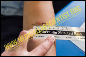 A negative on the second test suggests no prior exposure. Mantoux Tuberculin Skin Test
