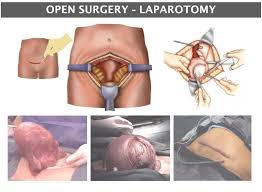 It could be fibroids, contact usa fibroid centers today! Fibroids Anthony Siow