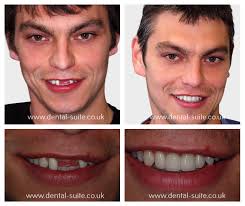 How much does a full set of teeth implants cost. Nottingham Dental Implants Implant Dentist The Dental Suite