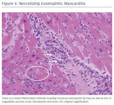 Myocarditis is inflammation of the myocardium, the muscles in the heart, according to medline plus. Fulminant Myocarditis A Review Of The Current Literature Usc Journal