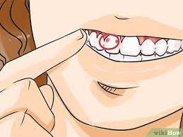 You may not have any symptoms at first. 3 Ways To Know If You Have A Cavity Wikihow