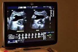 Reddit Shows People With Kidney Stones Have Been Less Likely To Seek Treatment During Pandemic Ucla