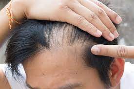 Dr leona yip, research fellow, st vincent's hospital, melbourne, australia, 2007. Hair Loss In Teens Causes Signs And How To Treat It Naturally