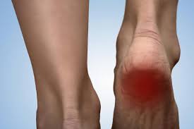 What are treatment options for a bone spur? Heel Spurs Symptoms Risk Factors And Treatment
