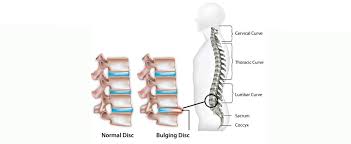 Practic, postoperator, pacientul prezinta o. VestÄƒ Pentru Hernia De Disc Move Flex Gel In Romania
