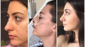 We did not find results for: Nose Job Experience All 15 Days After Surgery Rhynoplasty In Mexico Nose Job Diary Youtube