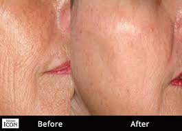 Maybe you would like to learn more about one of these? Non Ablative Fractional Laser Rejuvenation Dr Eyal Levit