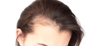 That your normal hair development will return. postpartum hair fall happens four months after delivery. 5 Ways To Deal With Postpartum Hair Loss Curated By Lever Ayush Dailyhunt