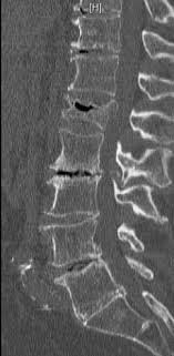 Design patterns are proven solutions to common development problems that can help us improve the organization and structure of our applications. Types Of Spinal Fractures
