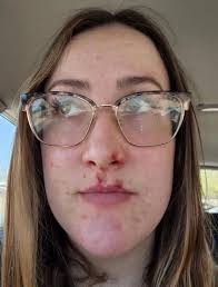 Signs of hormonal disorder Cushing's disease: How mum's 'sleeping beauty'  symptom was secret sign of shock diagnosis