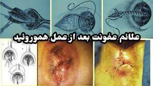 عکس قبل و بعد از عمل بواسیر + بواسیر چیست با عکس