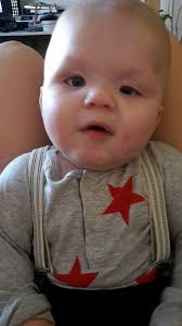 SÖKER MIN KROMOSOM-TVILLING! 1q21.1 microduplication och 21q21.3 deletion