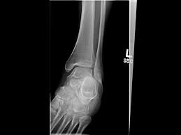 Fracture ankle maisonneuve injury fx foot fibula classification proximal malleolar disorders msk notes dislocation medial lateral occult. Ortho Dx A Fibula Fracture With Ankle Swelling Clinical Advisor