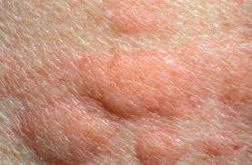 These symptoms typically come on over minutes to hours. Urticaria Angioedema And Anaphylaxis Sciencedirect