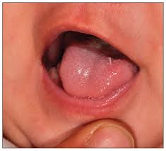 Image result for black hairy tongue symptoms