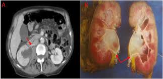 If you haven't been diagnosed but are worried about a symptom, find out more about the signs and sometimes breast cancer spreads to tissues and fluid that surround the brain and spinal cord. Metastatic Breast Cancer Masquerading As A Renal Malignancy A Literature Review And Case Report Sciencedirect