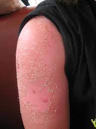 Alternatively, you can purchase a colloidal oatmeal bath powder such as aveeno at a drugstore. How To Treat Sunburn Itch At Home Fastmed Urgent Care