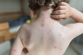 Image result for Skin Infection