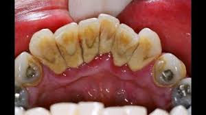 Artikel ini akan membincangkan apakah itu artikel ini akan membincangkan berkenaan scaling gigi atau cuci gigi ini dilakukan. Cuci Buang Karang Gigi Scaling Tartar Removal 1 Youtube