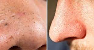 Lemon mengandung banyak vitamin c. Jangan Sampai Hidung Berkulat Buang Blackhead Dan Whitehead Sebelum Raya Pesona Pengantin