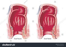 995 imágenes, fotos de stock, objetos en 3D y vectores sobre Anal fissure |  Shutterstock