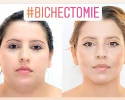 Les cicatrices sont des traces indélébiles laissées par une blessure profonde. Corriger Un Bec De Lievre En Restructurant Les Levres Avec La Chirurgie Reparatrice Martigues 13 Docteur Nicolas Lari