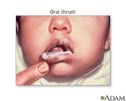 Image result for oral thrush symptoms roof of the mouth