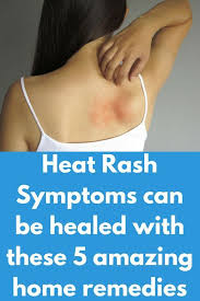 Heat Rash Symptoms Can Be Healed With These 5 Amazing Home Remedies Heat Rashes Can Be Experienced By Someone From Any Heat Rash Heat Rash Remedy Rash Symptoms