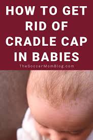Image result for Cradle Cap