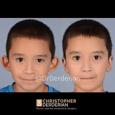 The Art of Natural-Looking Ears: Otoplasty Techniques and Results — Dr  Derderian — Plastic and Reconstructive Surgery