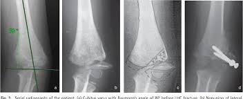 Image result for Lateral Condyle Fracture