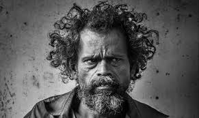 Image result for Hypertrichosis