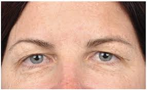 We did not find results for: Hooded Eyelids What They Actually Look Like Sophia Porter