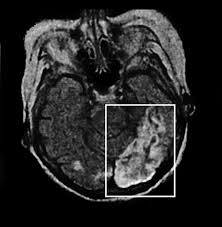 El accidente cerebrovascular agudo (acva) se produce cuando se interrumpe repentinamente el suministro de sangre a una parte del cerebro o cuando se rompe un vaso sanguíneo en el cerebro. Fig A11 Anopsia O Hemianopsia Producida Por Accidente Cerebrovascular Download Scientific Diagram