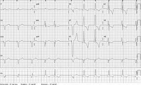 Baseline drift should not be misdiagnosed as pacemaker dysfunction. Is This Pacemaker Functioning Abnormally Circulation