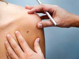 Pitting or thickening of the skin of the breast so that it may look and feel like an orange peel. Skin Cancer Rash Itchiness And Symptoms