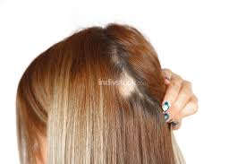 Buy health & beauty supplies online and read professional reviews on caucasian hair relaxers hair care. 30 Year Old Caucasian Woman With Spot Alopecia Bald Spot On Her Backgrounds Textures Indivstock