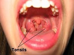 Image result for Tonsillitis